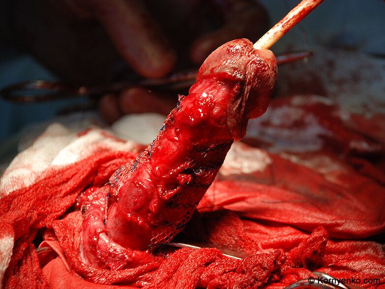 Installatioun vun enger Kollagen Matrix fir Penisvergréisserung