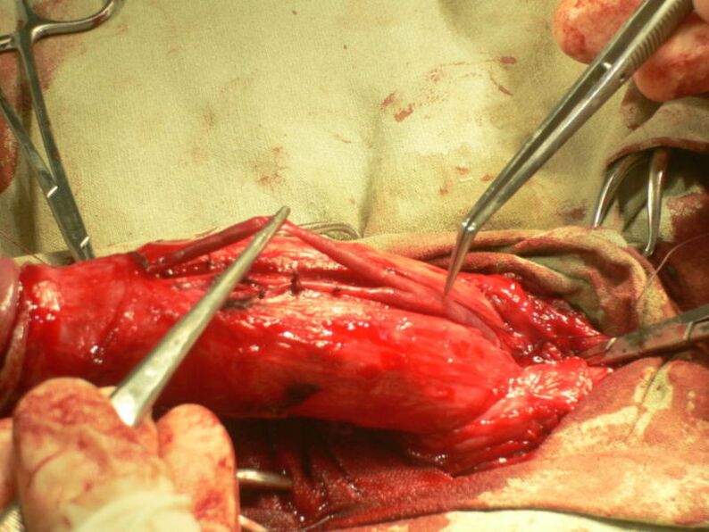 Lipofüllung vum Penis fir Erweiderung