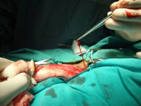 Penis Erweiderung Chirurgie